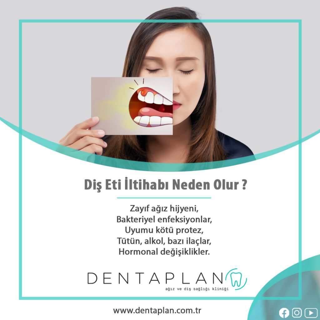 Diş Eti İltihabı Neden Olur?