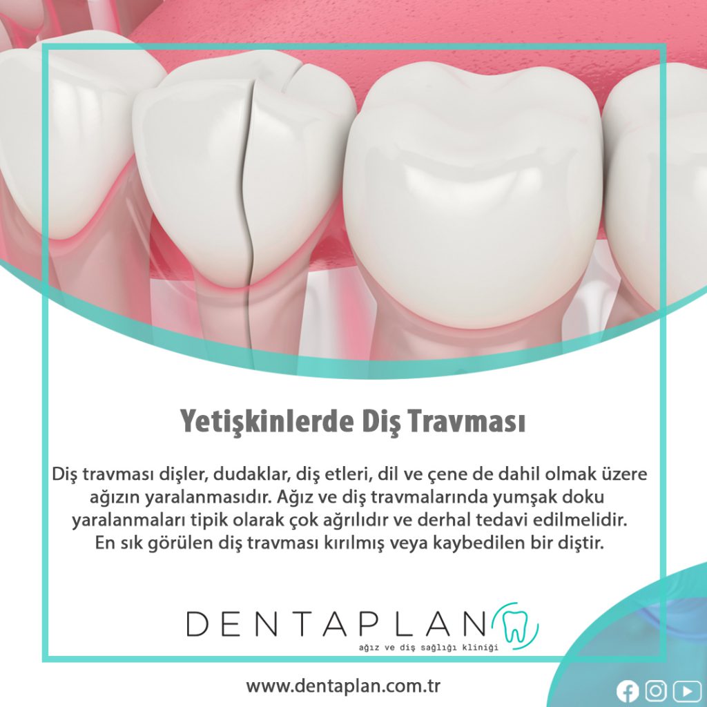 Yetişkinlerde Diş Travması