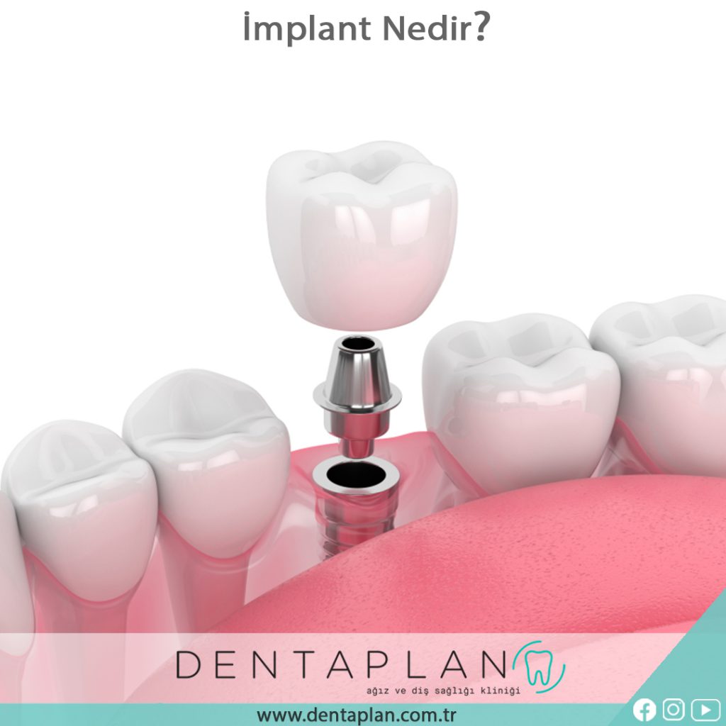İmplant Nedir?